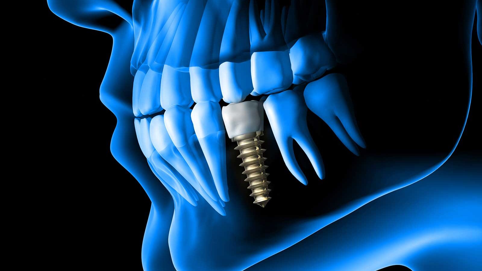 Illustration of a dental implant in the jaw