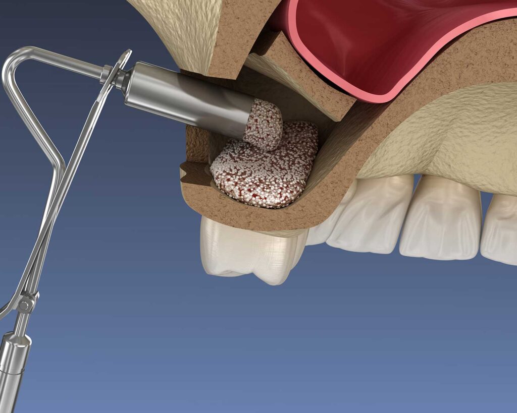 Illustration of a sinus lift with graft material under the sinus membrane