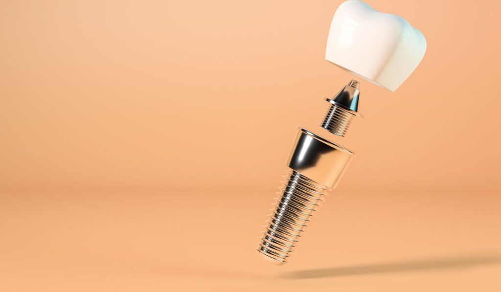 Dental implant, abutment and crown: the parts behind dental implants cost