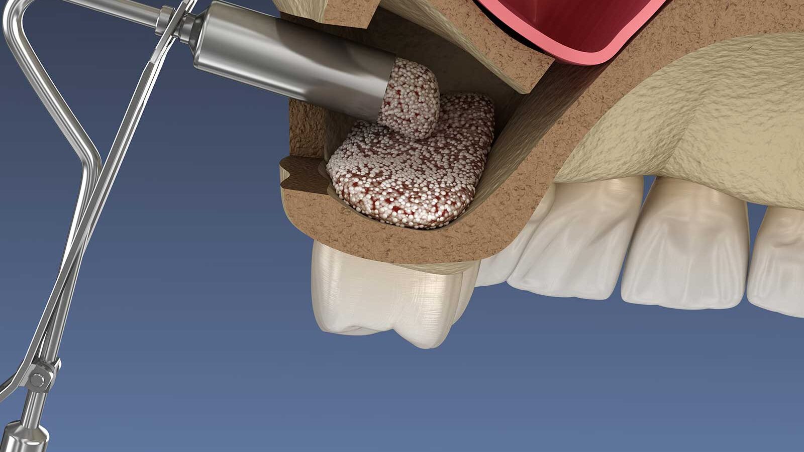 Illustration of sinus floor augmentation